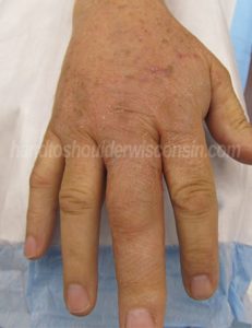 Infekce prstu
