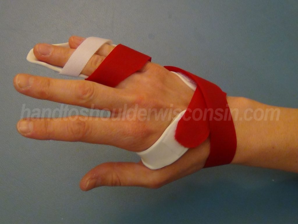 Hand to Shoulder Center of Wisconsin | Dupuytren's contracture